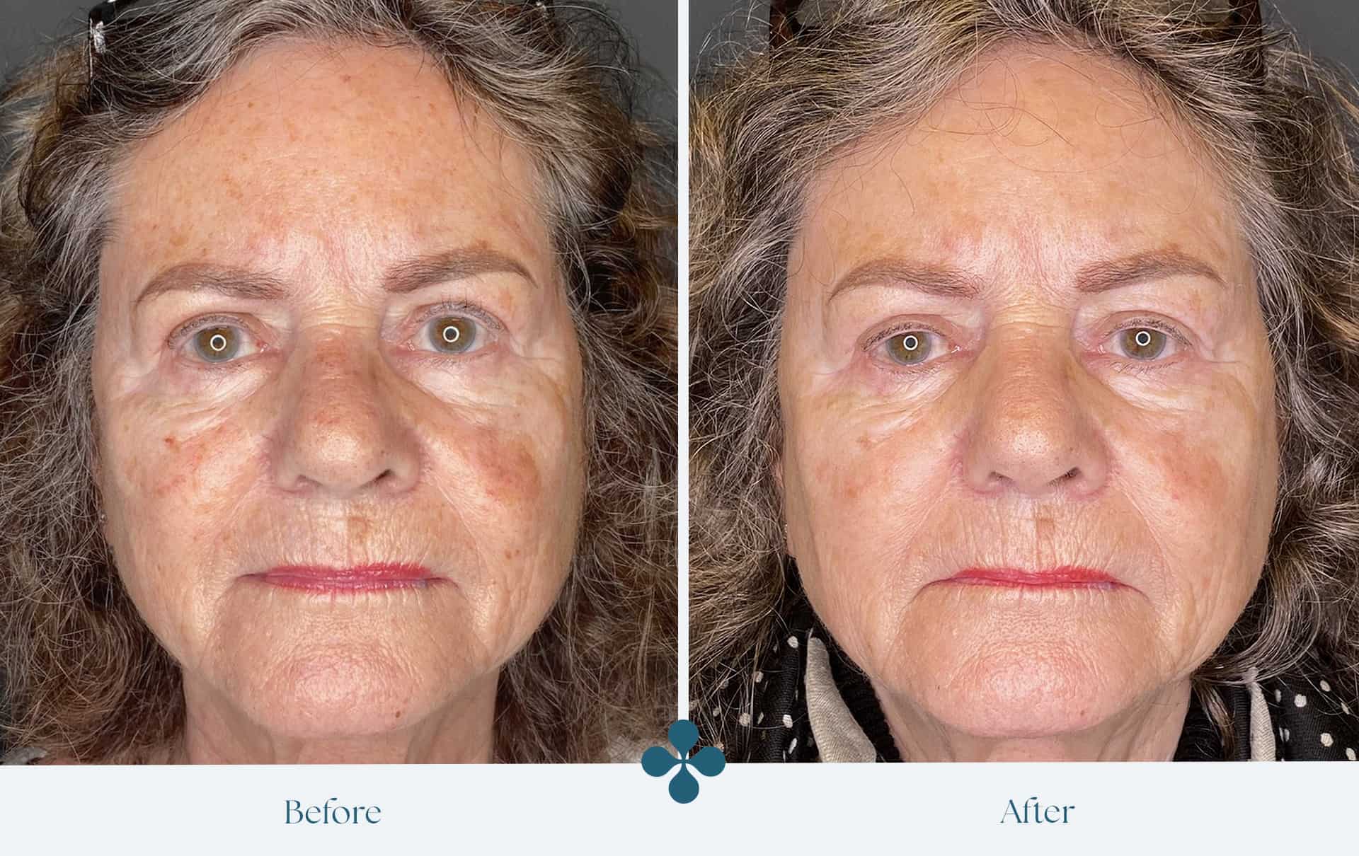 Melasma voor 