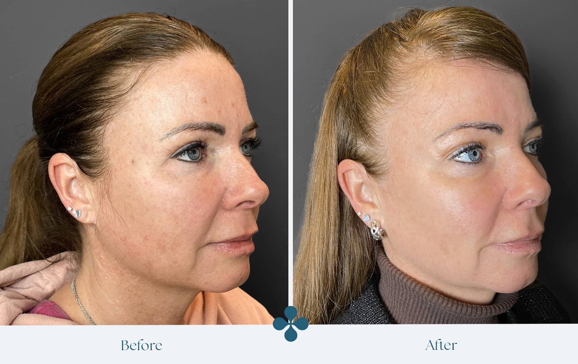 Melasma voor 