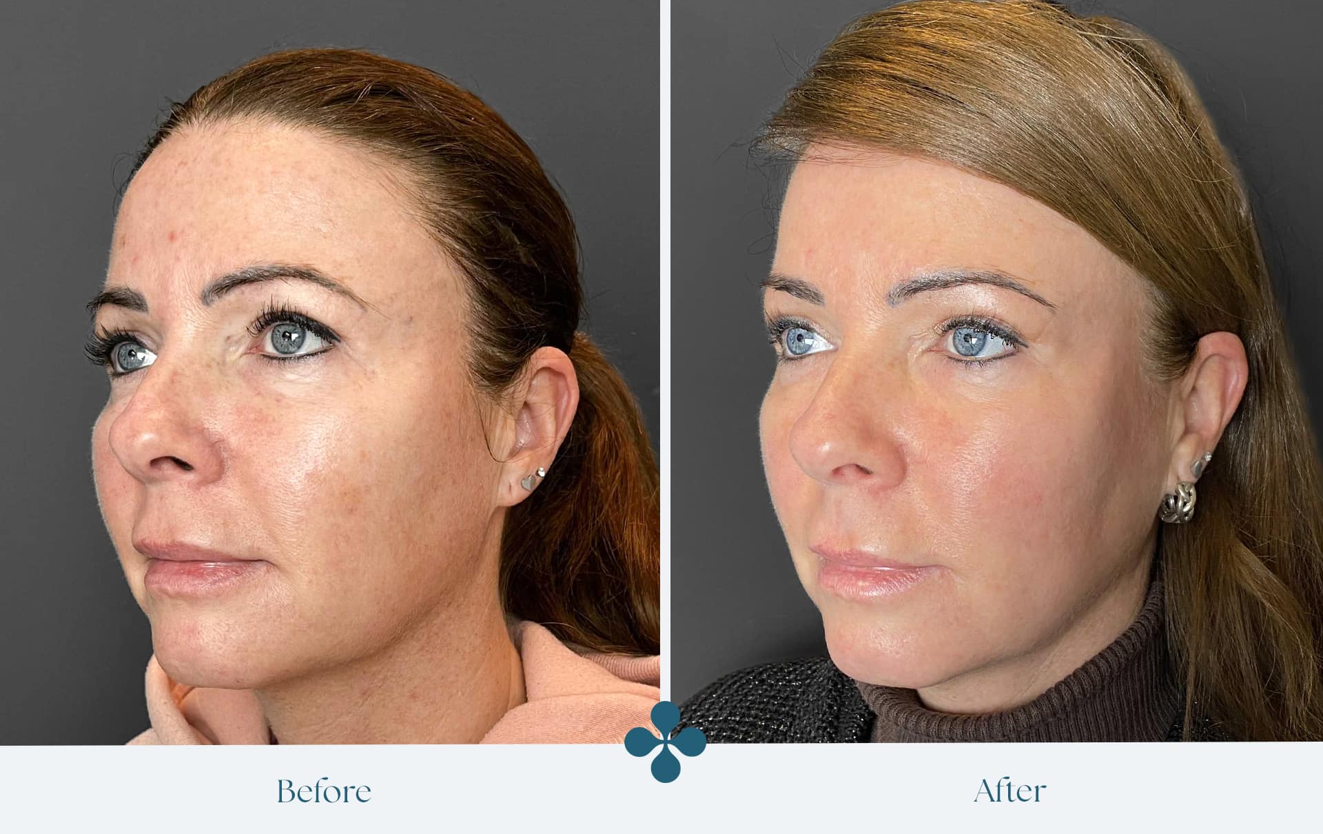 Melasma voor 