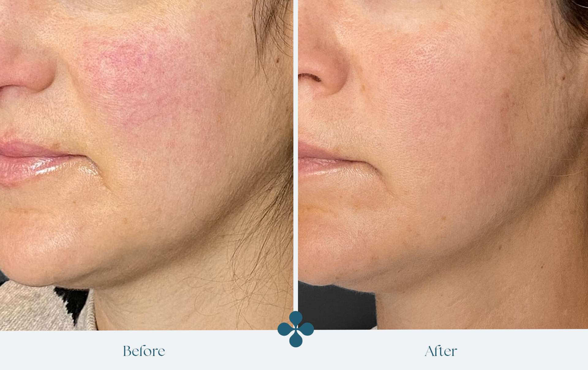 Melasma voor 