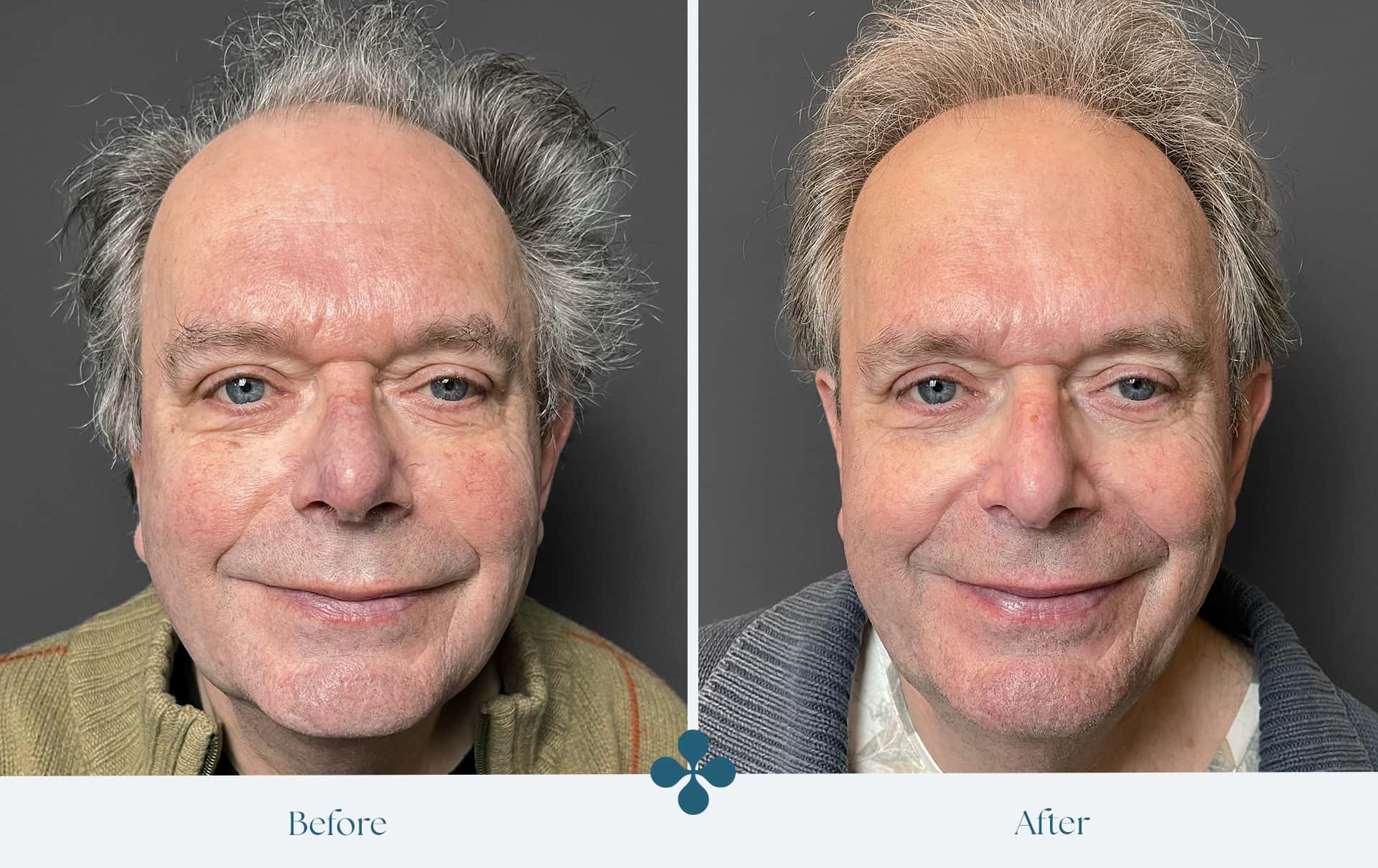 Voor en na resultaten Van Lennep Kliniek
