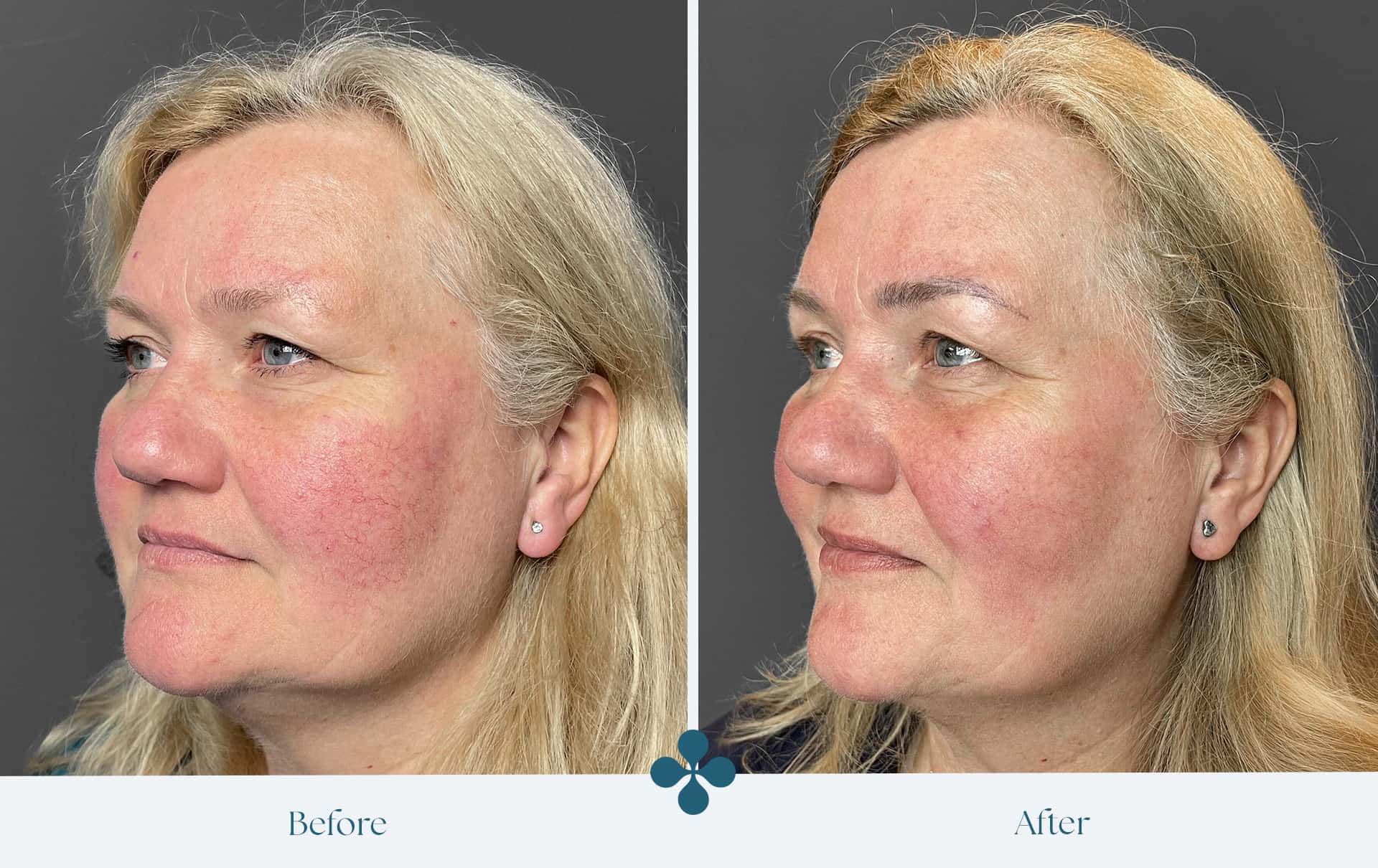 Melasma voor 