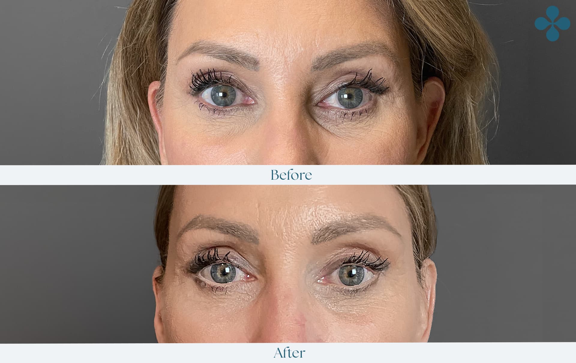 Melasma voor 
