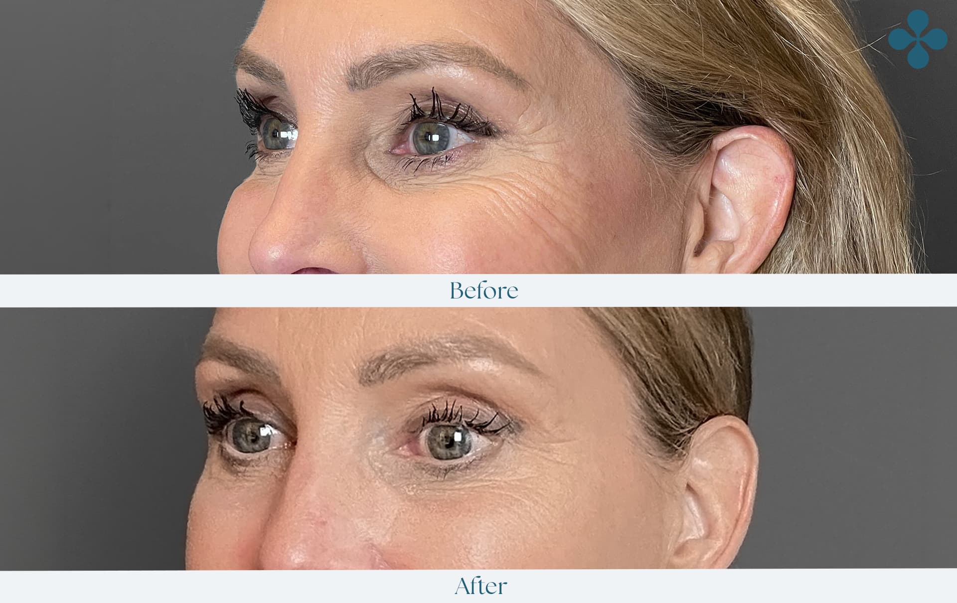 Melasma voor 