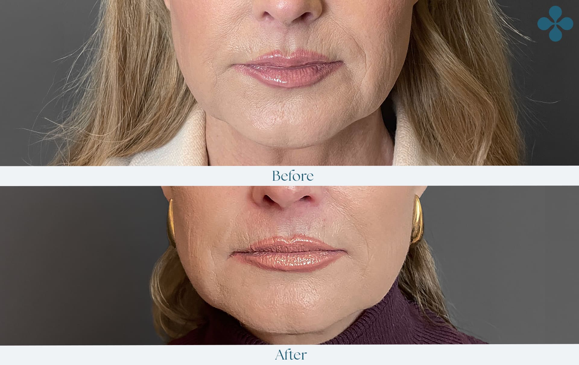 Melasma voor 