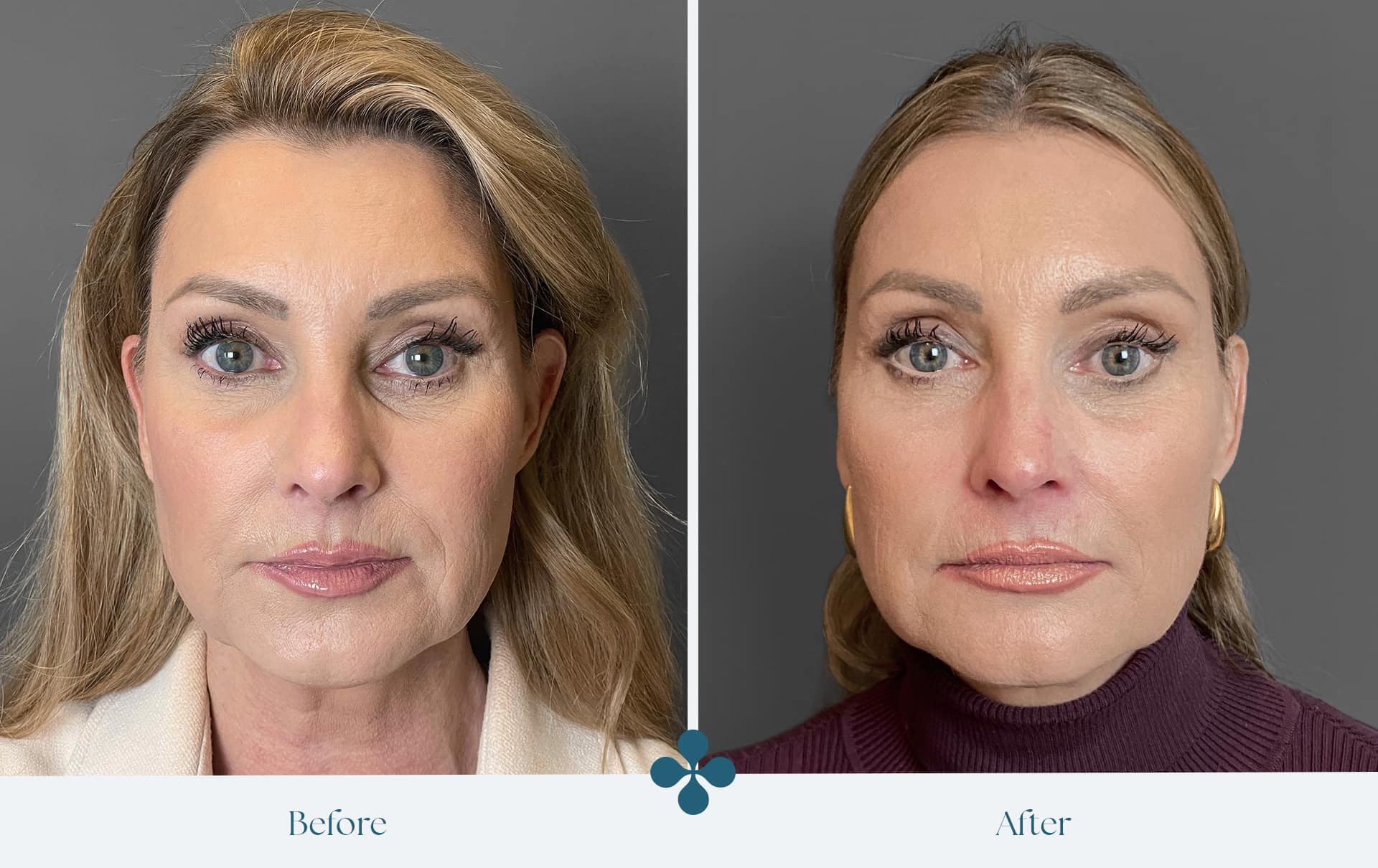Melasma voor 