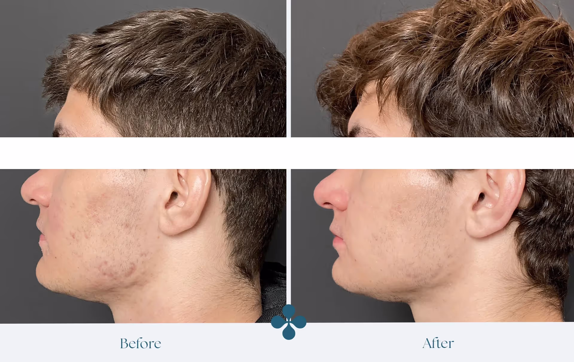 Before and after results at Van Lennep Kliniek