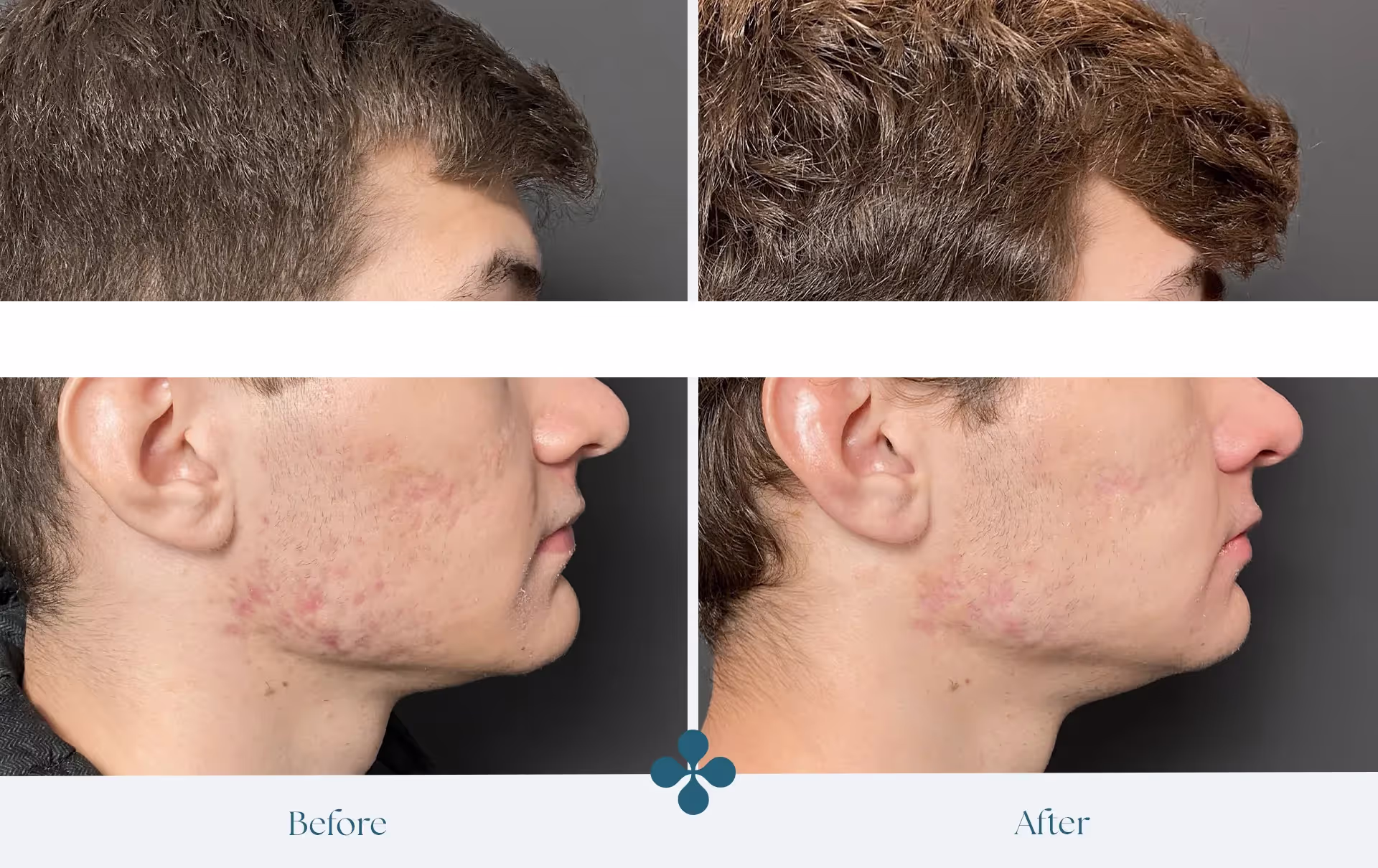Before and after results at Van Lennep Kliniek