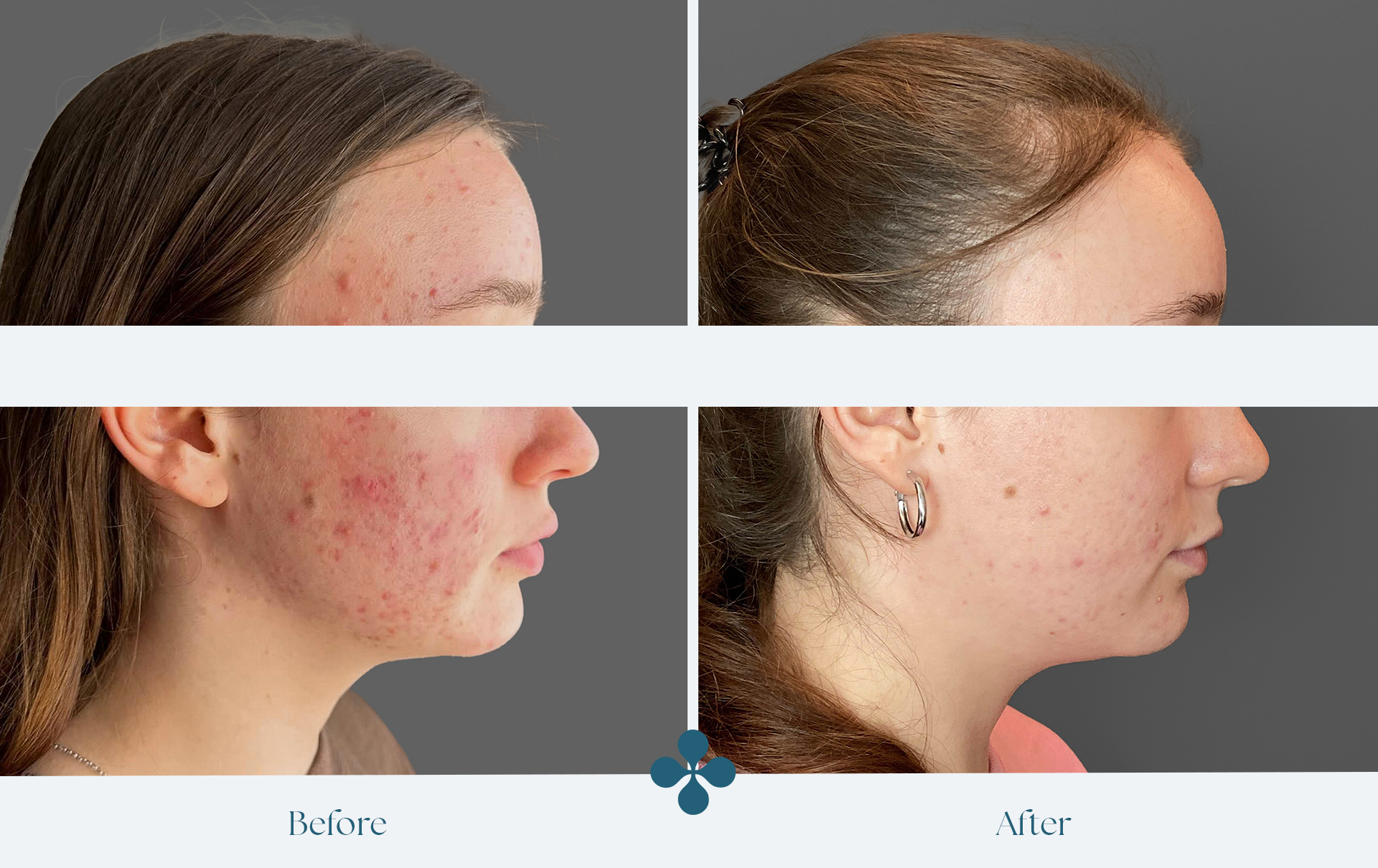 Before and after results at Van Lennep Kliniek