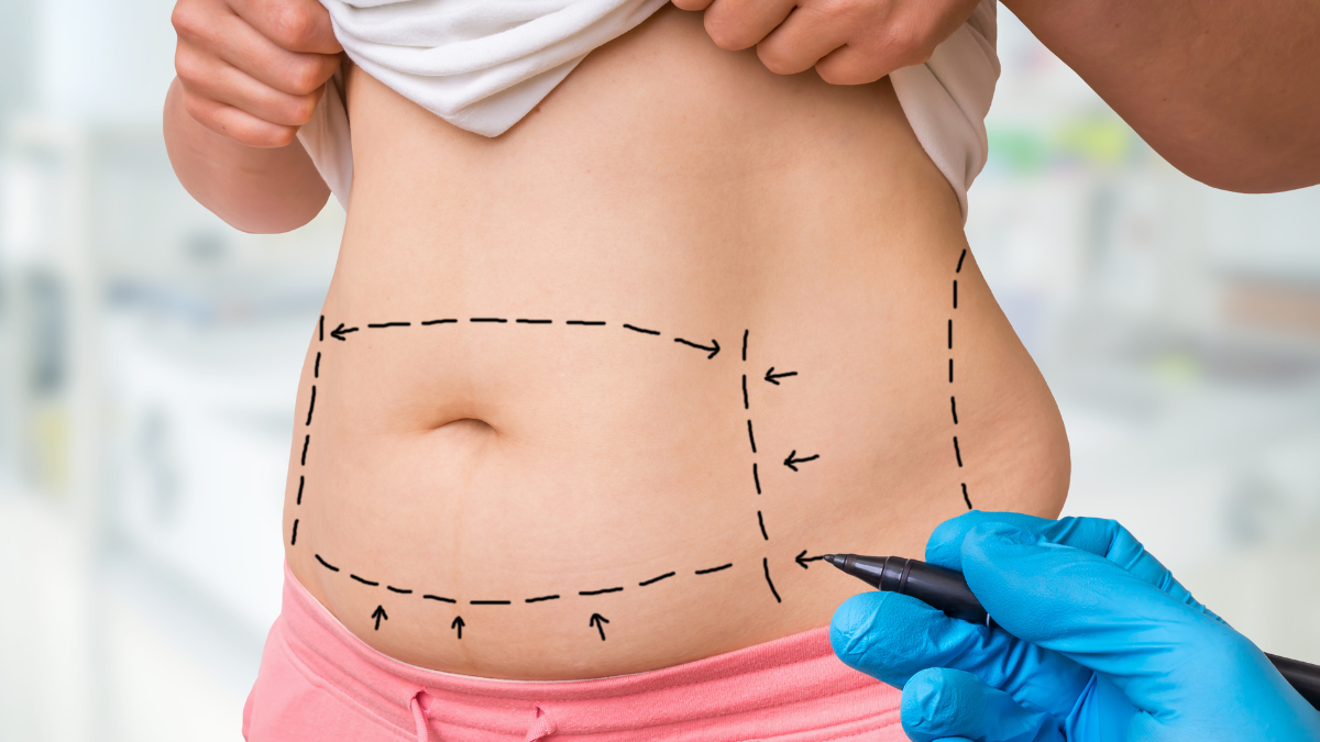 A plastic surgeon outlining the incisions for an upcoming procedure.