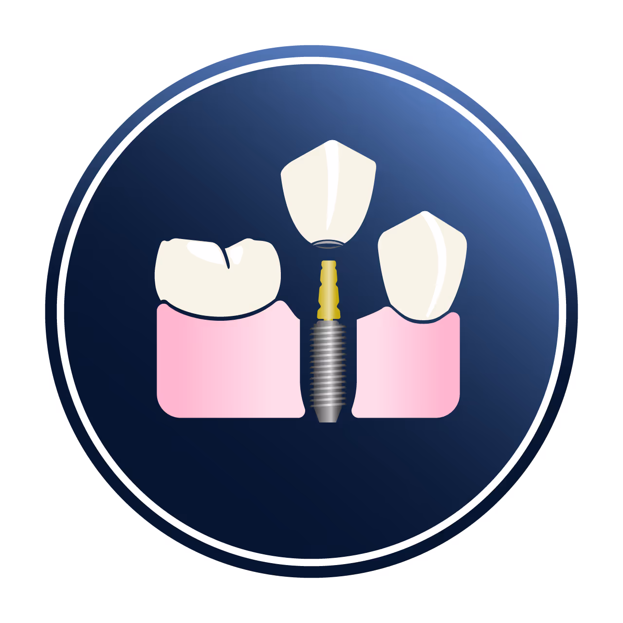 Icon of implant