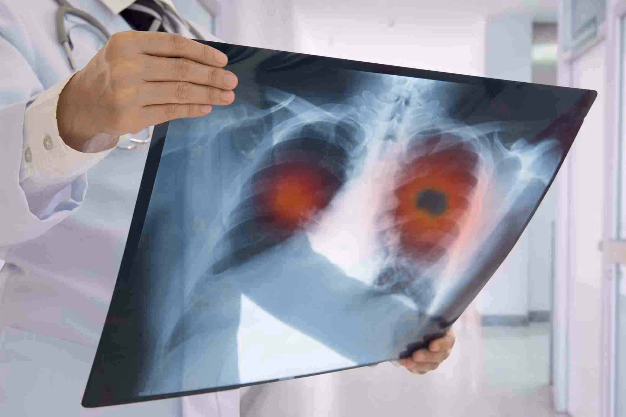 Patient is experiencing mesothelioma after asbestos exposure at work.