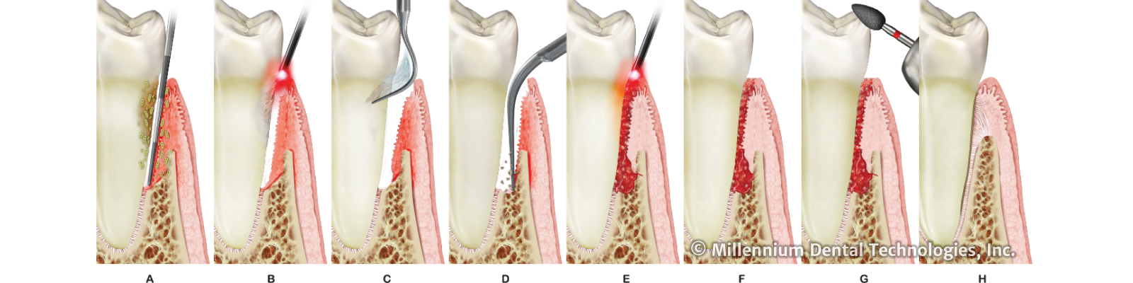 LANAP Protocol steps A through H — First Dental Care Anaheim
