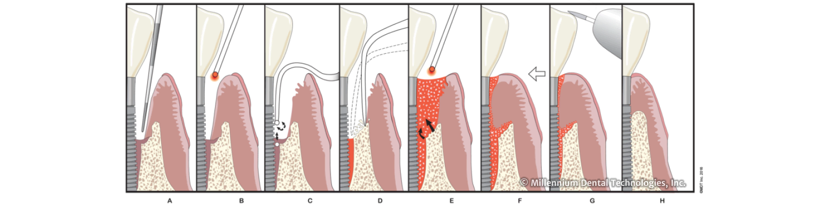 LAPIP™ Protocol steps A through H — First Dental Care Anaheim