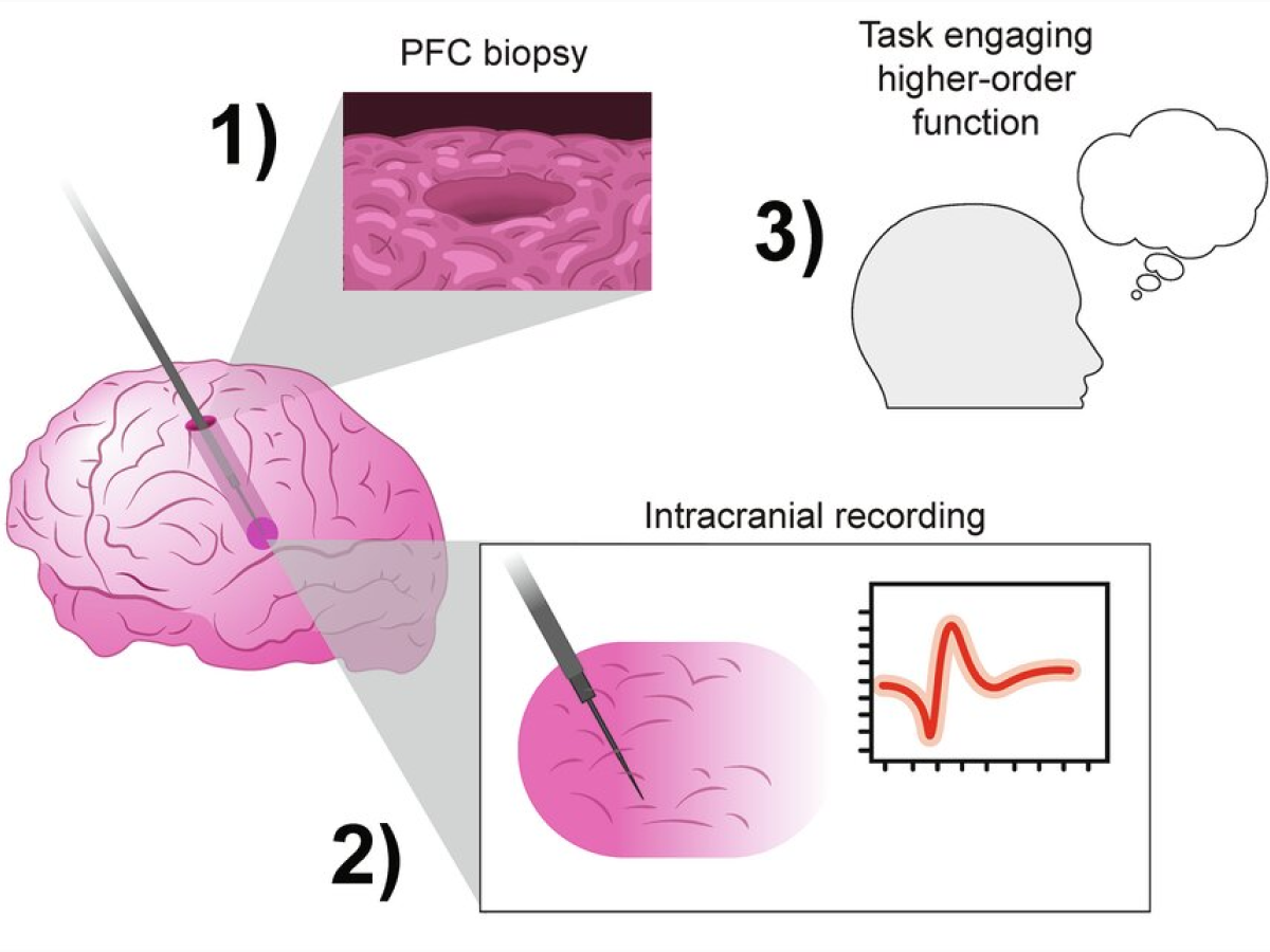 Diagram showing data collection procedures including a brain biopsy, intracranial recording, and a task engaging higher-order brain function.