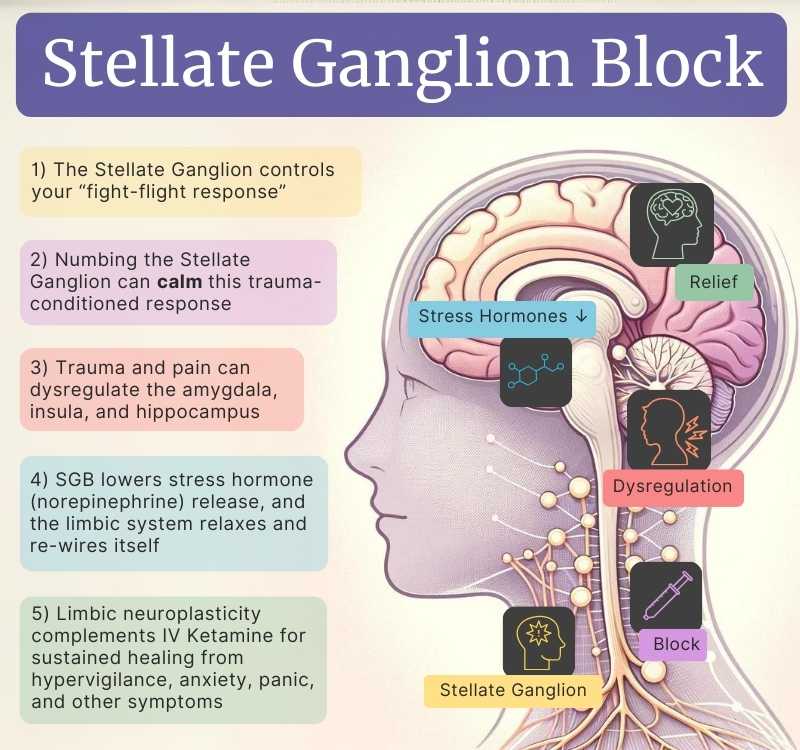 infographic of the stellate ganglio block (SGB) also called dual sympathetic reset (DSR) showing show it reduces PTSD symptoms
