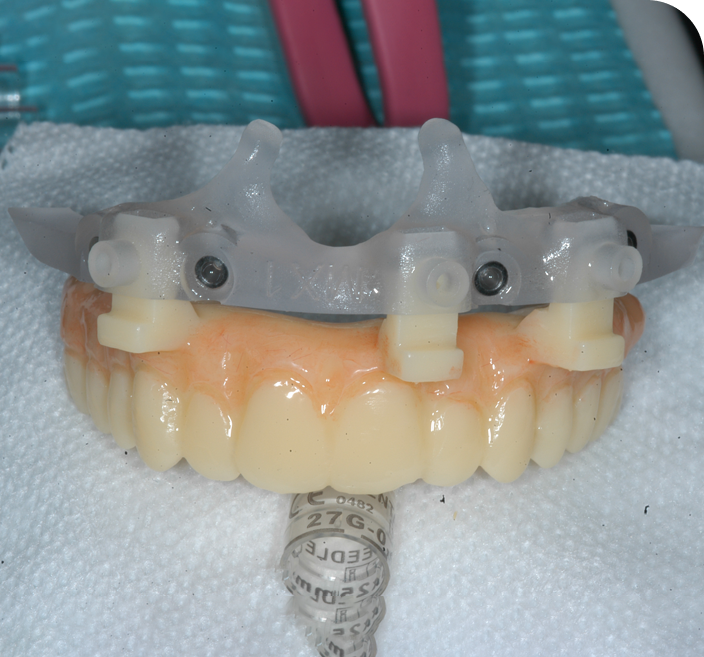 Full Arch Stackable Surgical Guide With Hybrid PMMA Restoration