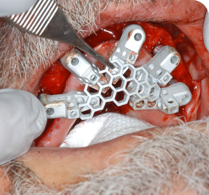 OptiSplint Full Arch Surgery