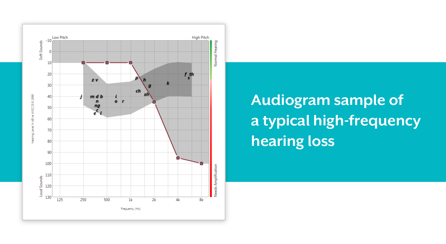 Example audiogram showing high-frequency loss pattern (image courtesy Starkey)