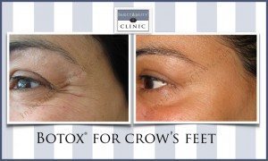 crows feet