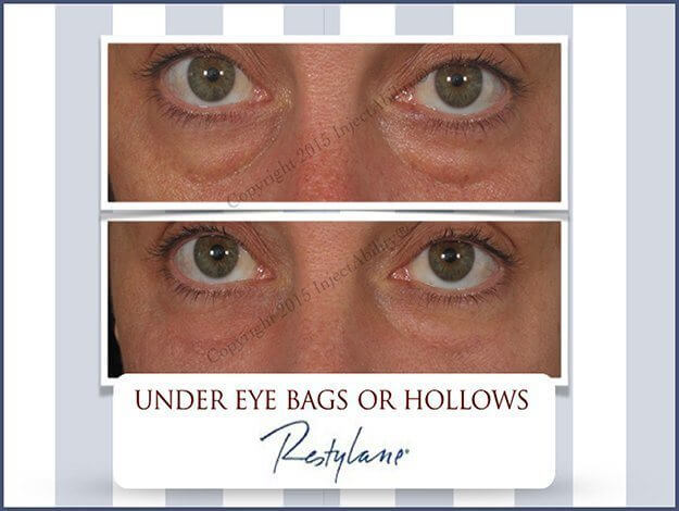under eye hollows