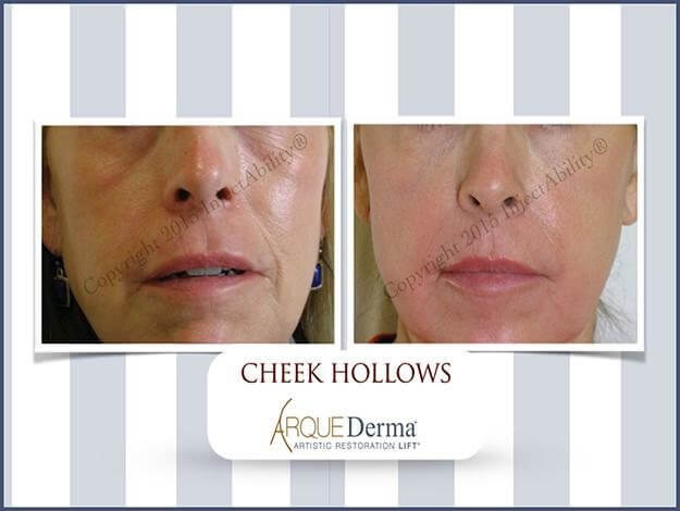 cheek hollows