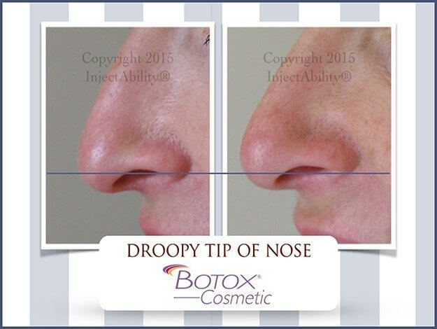 droopy tip of nose
