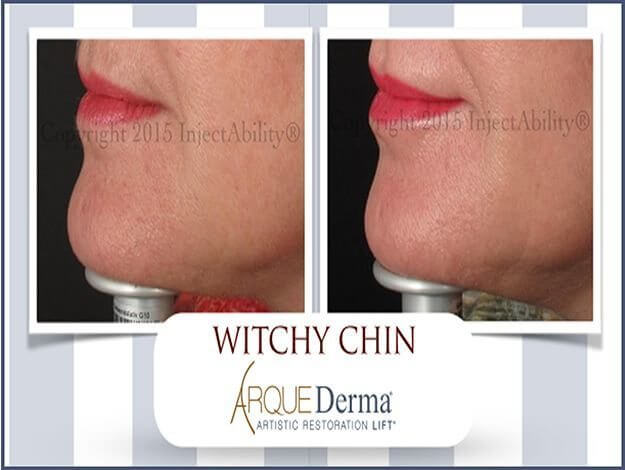 witchy chin