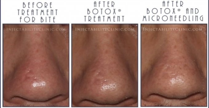 micro.prp before and after