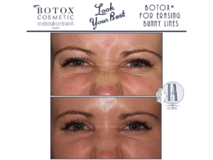 botox bunny lines
