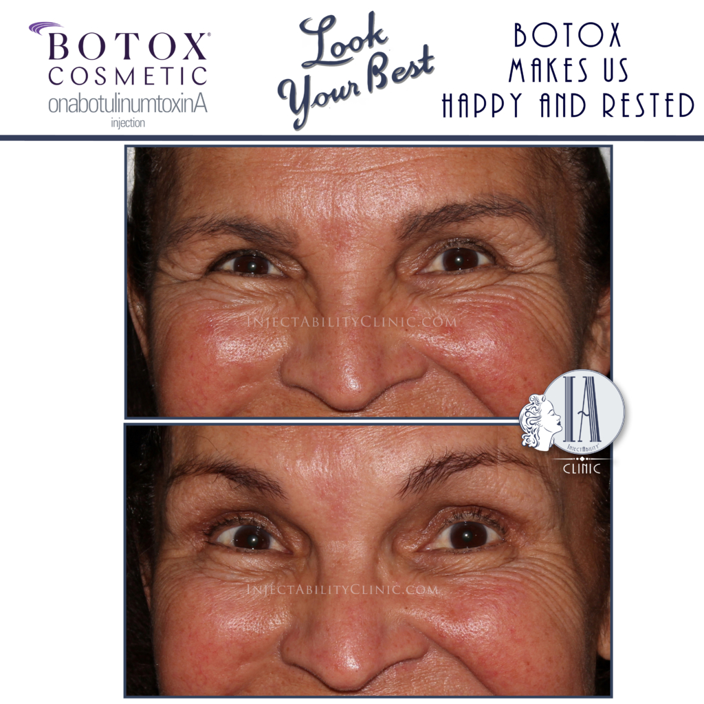 Botox InjectAbility Clinic Torrance CA scaled