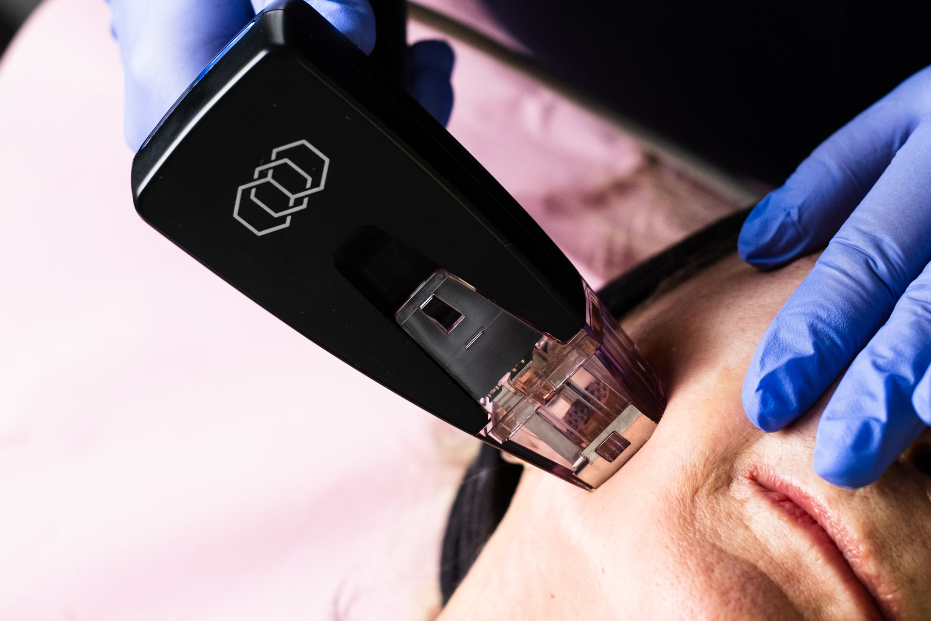 Aplicacion de Morpheus8 en Valencia