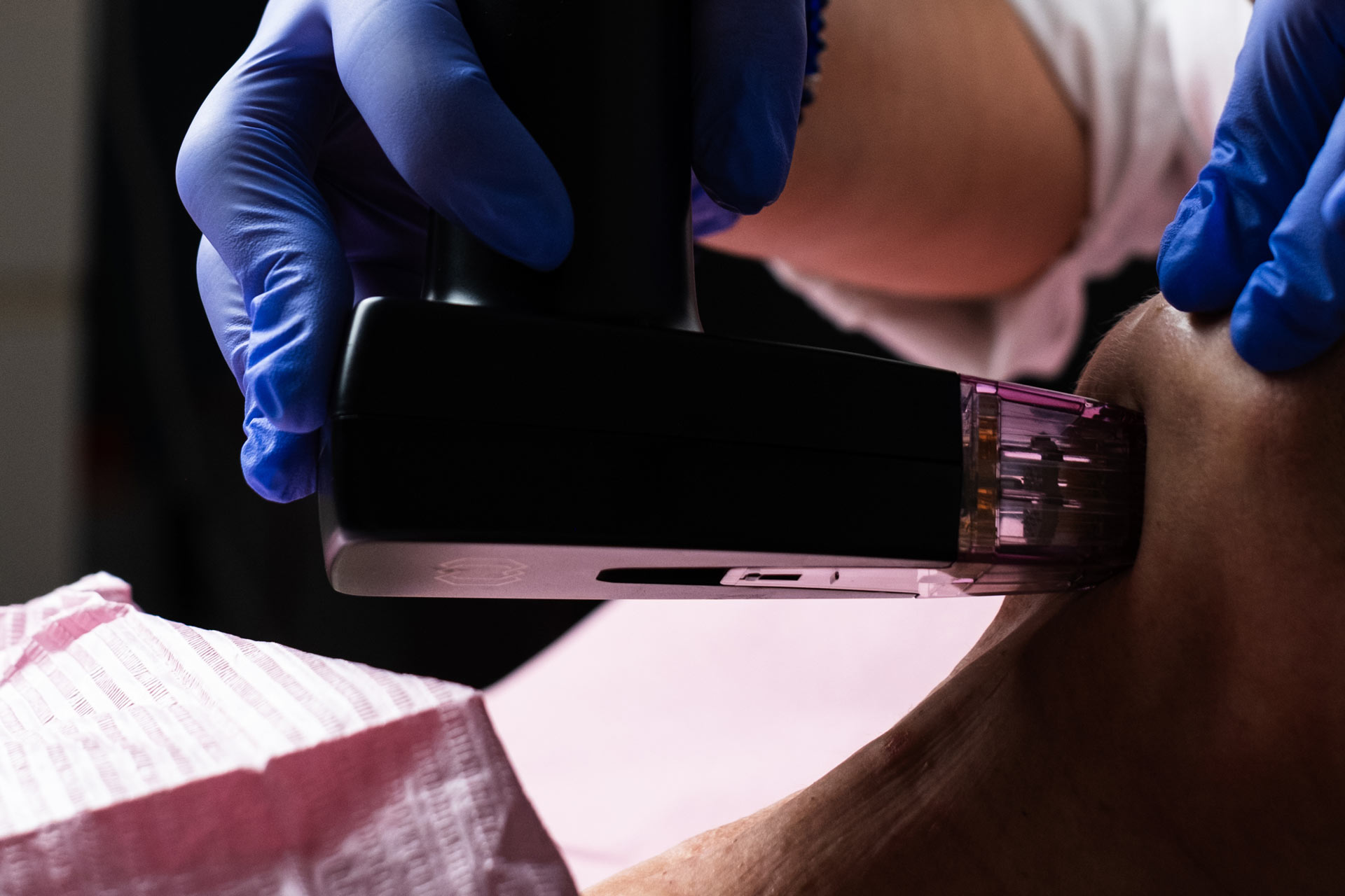 Morpheus 8 en Valencia: redefine tu piel y contorno sin cirugía