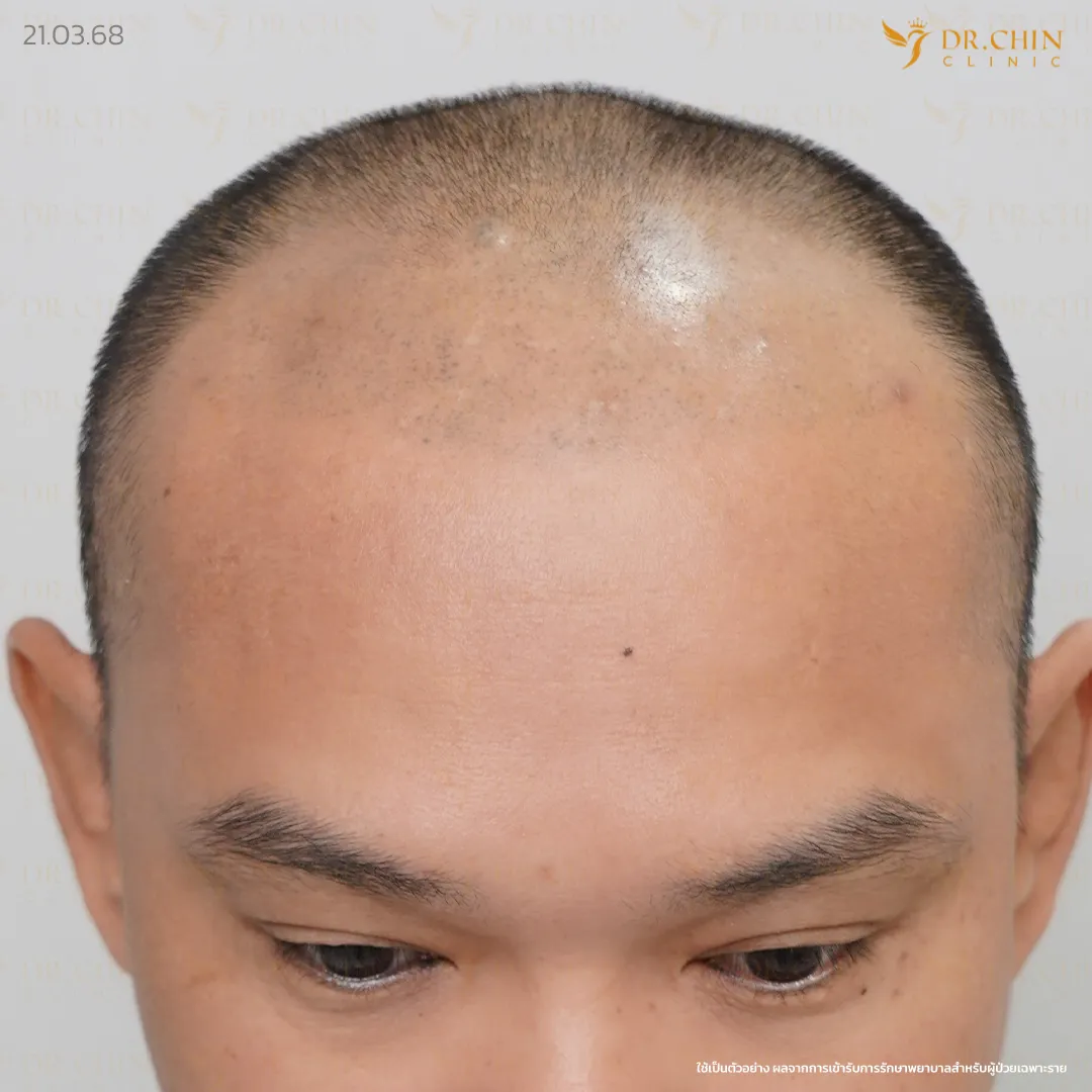 ภาพก่อนปลูกผมทับรอยสักบริเวณแนวผมด้านหน้า