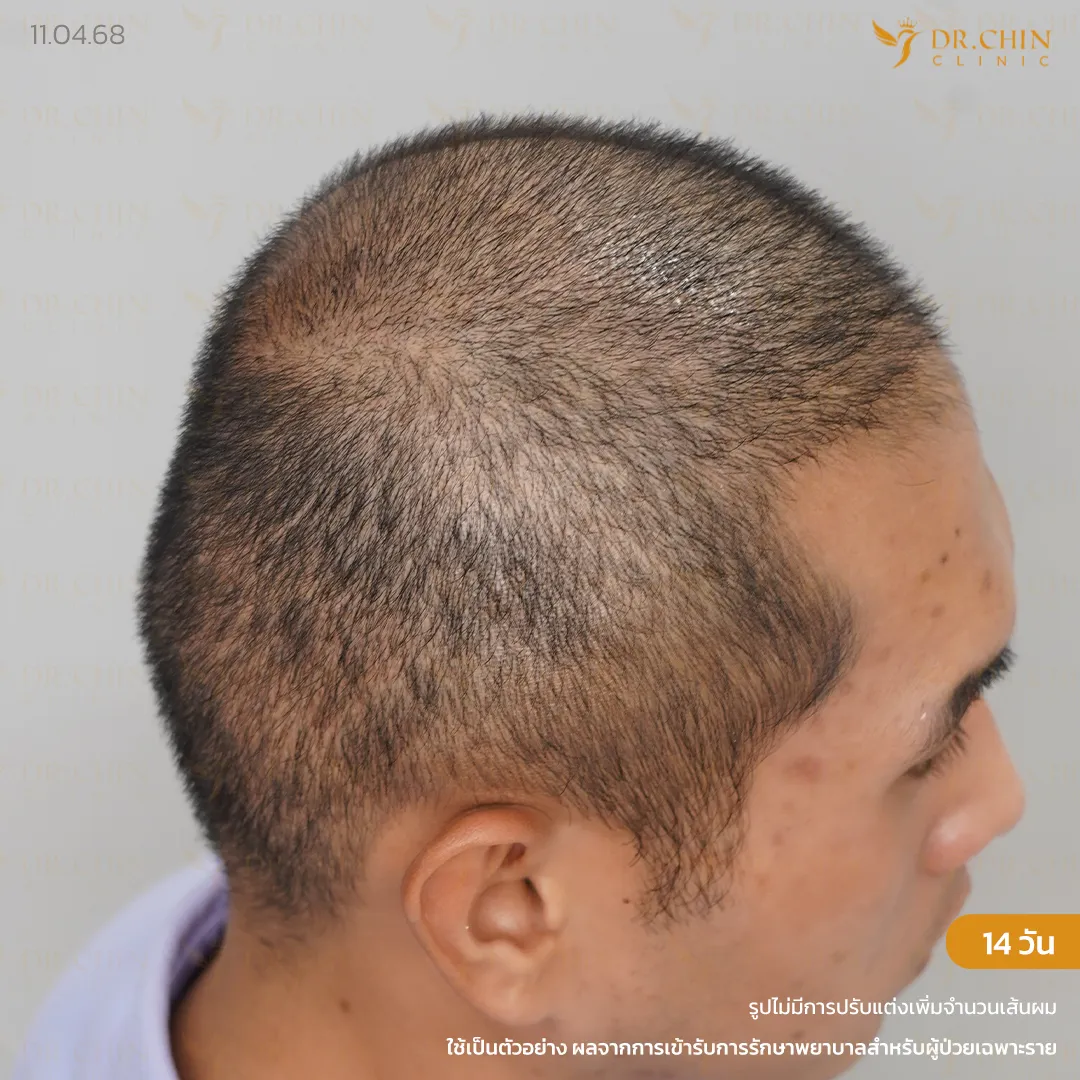 รีวิวแก้ปลูกผมหลังทำ 14 วัน บริเวณกลางศีรษะ