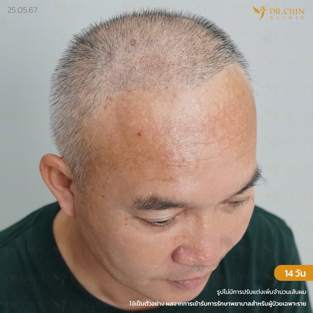 รีวิวแก้ปลูกผมหลังทำ 14 วัน โดยหมอชิน คลินิก นครสวรรค์