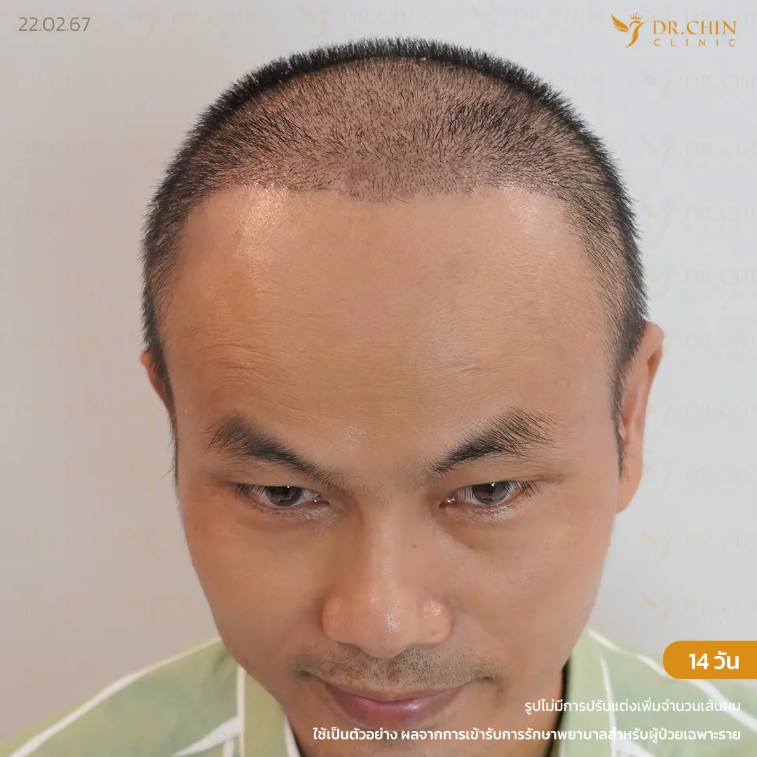 รีวิวแก้ปลูกผมหลังทำ 14 วัน แนวผมด้านหน้า