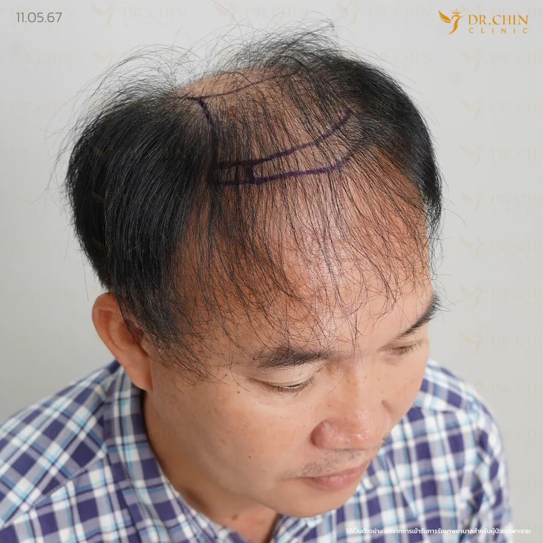 ภาพก่อนแก้ปลูกผม แนวผมเดิมและความหนาแน่นของเส้นผมที่ต้องประเมินใหม่