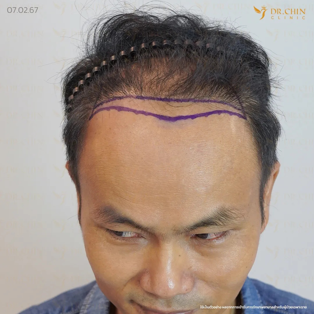 ภาพก่อนแก้ปลูกผม แนวผมด้านหน้าที่ต้องวางแผนปรับใหม่