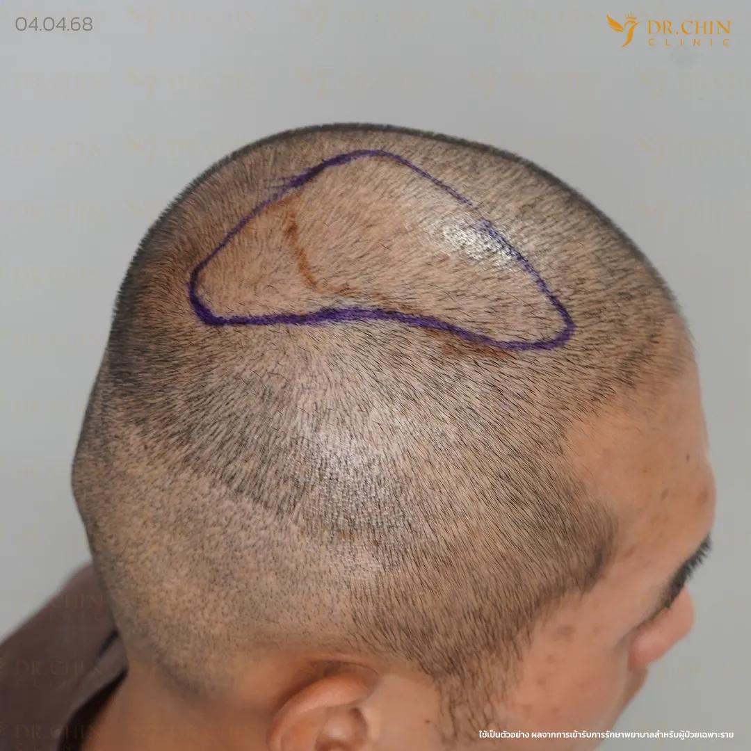 ภาพก่อนแก้ปลูกผม บริเวณกลางศีรษะที่ต้องประเมินแนวปลูกใหม่
