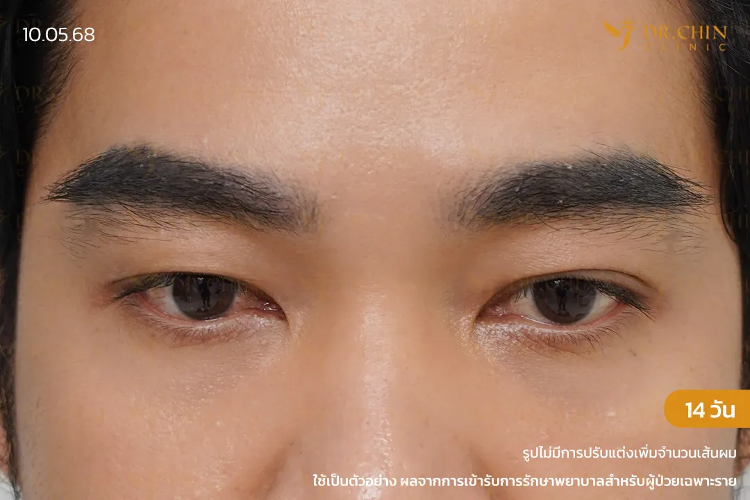 รีวิวปลูกคิ้วหลังทำ 14 วัน คิ้วดูเข้มขึ้นและแนวคิ้วชัดขึ้น ที่หมอชิน คลินิก นครสวรรค์