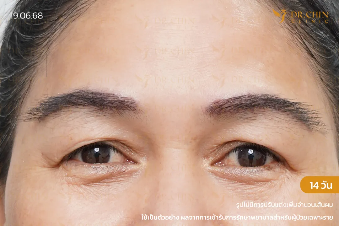 รีวิวปลูกคิ้วหลังทำ 14 วัน เพิ่มความหนาแน่นของคิ้วและปรับทรงคิ้วให้ชัดขึ้น ที่หมอชิน คลินิก นครสวรรค์