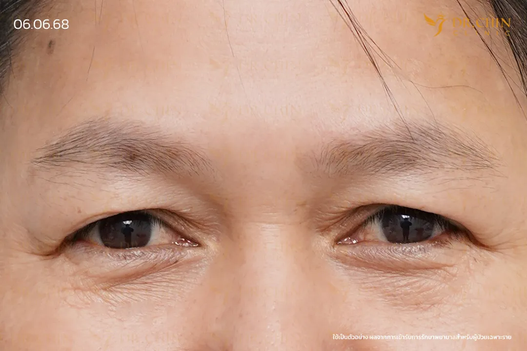 รีวิวปลูกคิ้วก่อนทำ เคสคิ้วบางมากและรูปทรงคิ้วยังไม่ชัด ที่ Dr. Chin Clinic