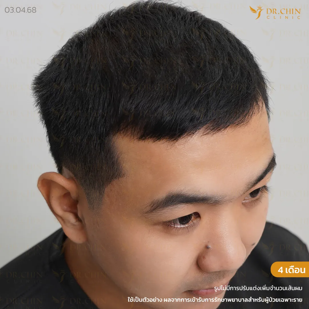 หลังปลูกผม DHI 4 เดือน เคสเติมแนวผมด้านหน้าและขมับให้ดูเต็มขึ้น
