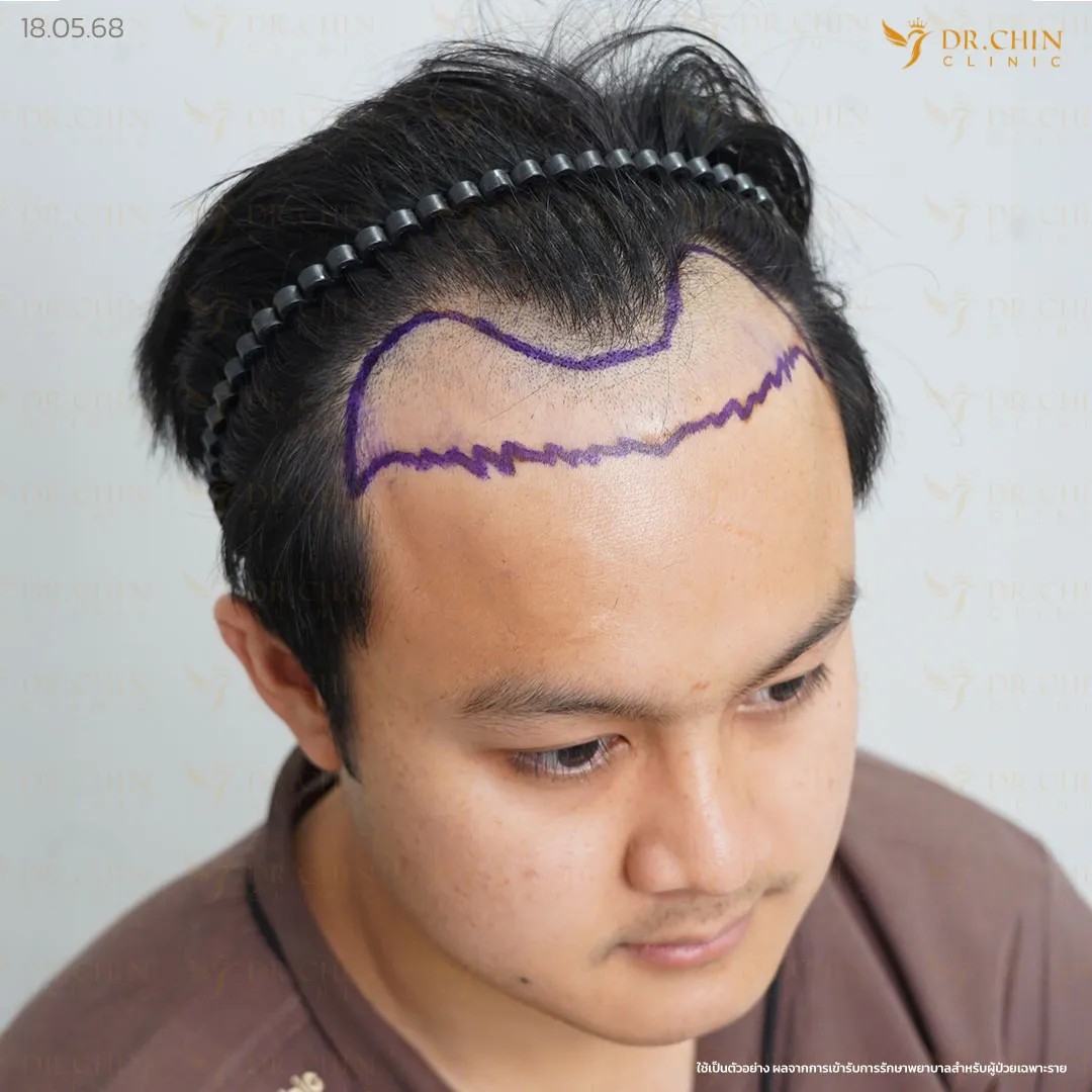 ก่อนปลูกผม DHI เคสแนวผมเว้าเป็นรูปตัว M และขมับลึก Doctor Chin Clinic