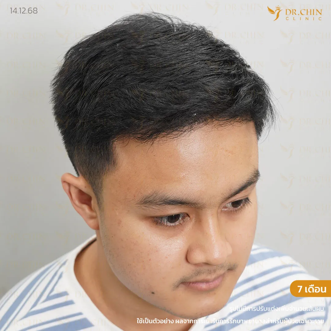 หลังปลูกผม DHI 7 เดือน เคสแก้แนวผมตัว M และเติมขมับให้ดูเป็นธรรมชาติ