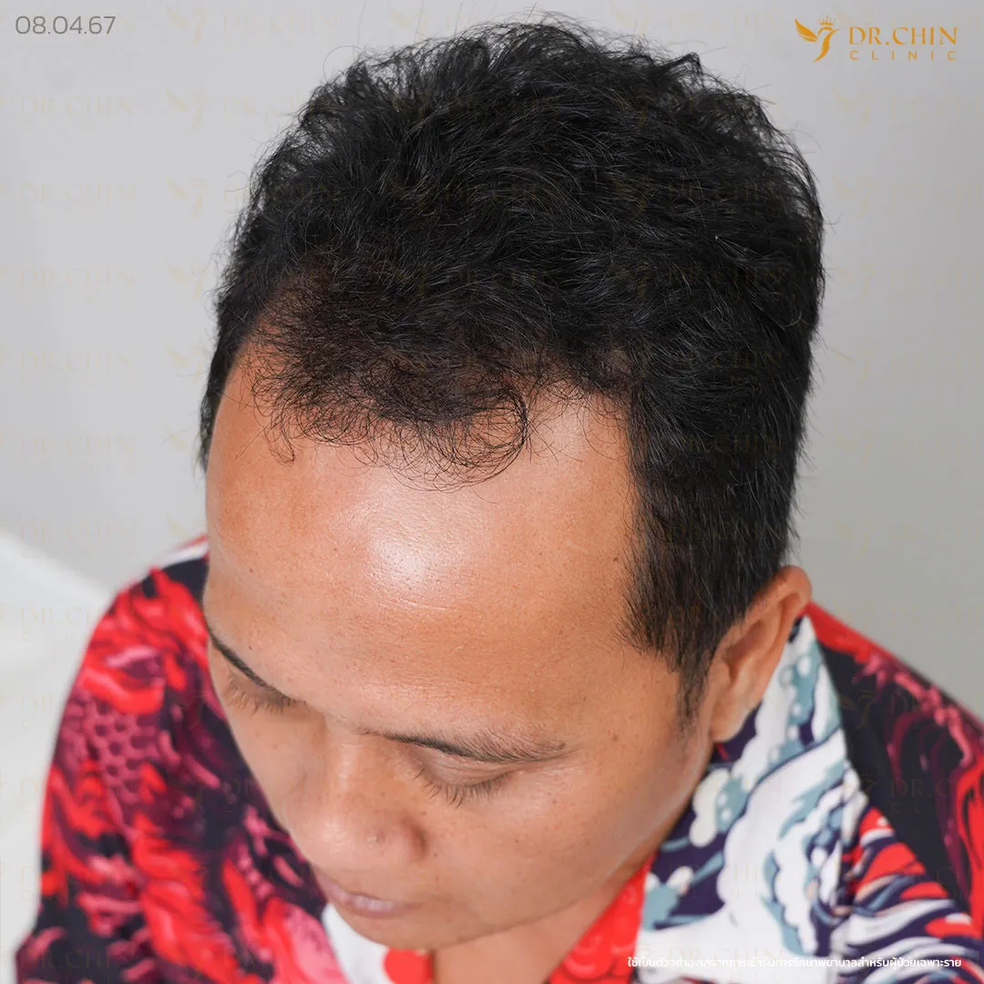ก่อนปลูกผม DHI เคสแนวผมถอยด้านหน้าและขมับลึก Doctor Chin Clinic