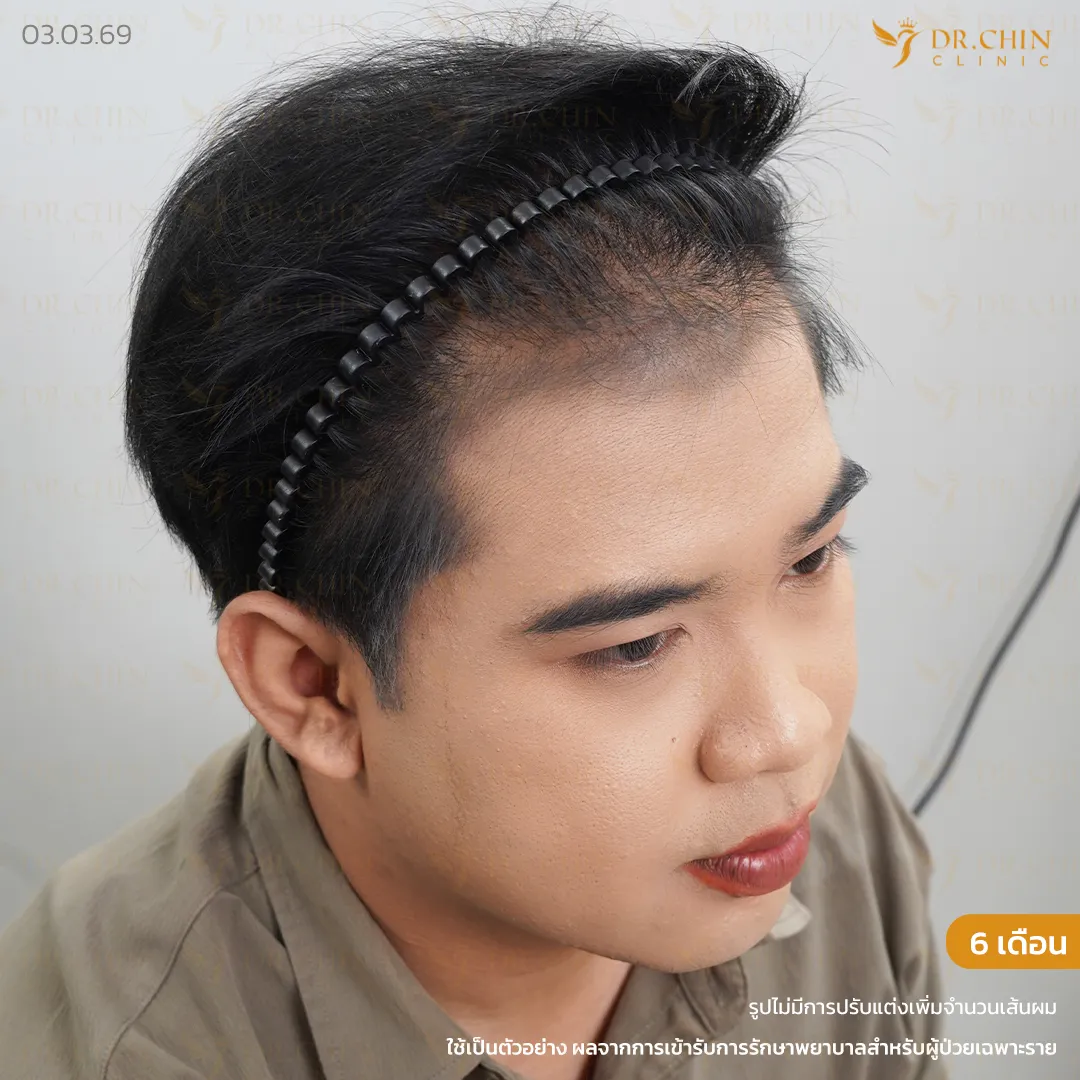หลังปลูกผม DHI 6 เดือน เคสเติมแนวผมด้านหน้าและขมับให้เป็นธรรมชาติ
