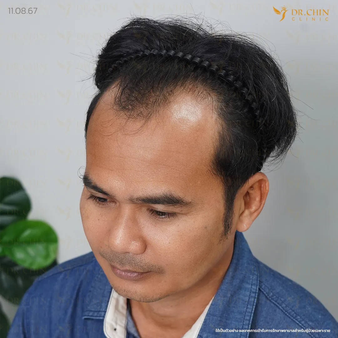 ก่อนปลูกผม DHI เคสแนวผมถอยและขมับเว้า Doctor Chin Clinic นครสวรรค์