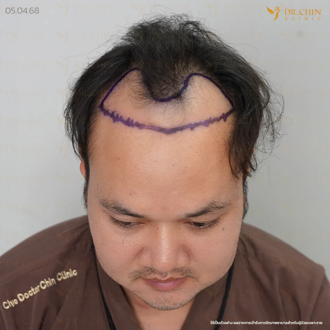 ก่อนปลูกผม DHI เคสแนวผมเว้าเป็นรูปตัว M และหน้าผากกว้าง Doctor Chin Clinic นครสวรรค์